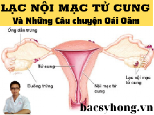 Lạc nội mạc tử cung gây vô sinh và những câu chuyện oái oăm giờ mới kể - Bác sỹ Hồng